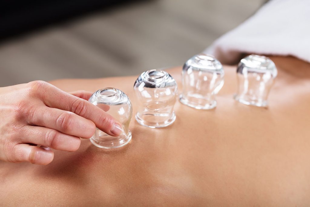 What is Cupping Therapy? The Uses Benefits and More