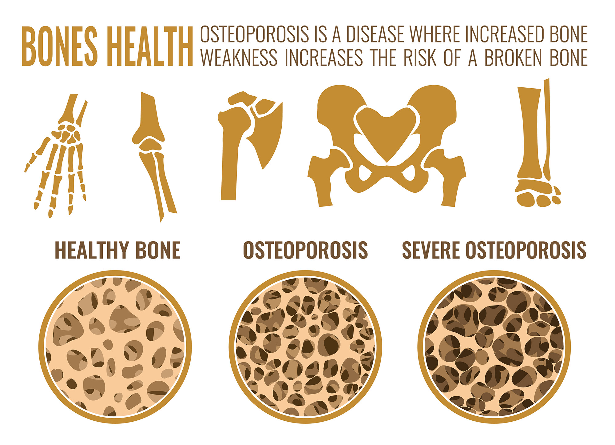 Preventing Osteoporosis